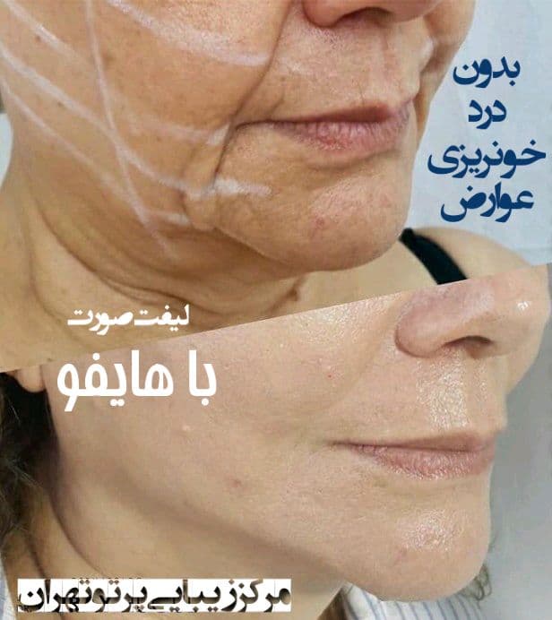 جراح-لیفت-صورت-تهران